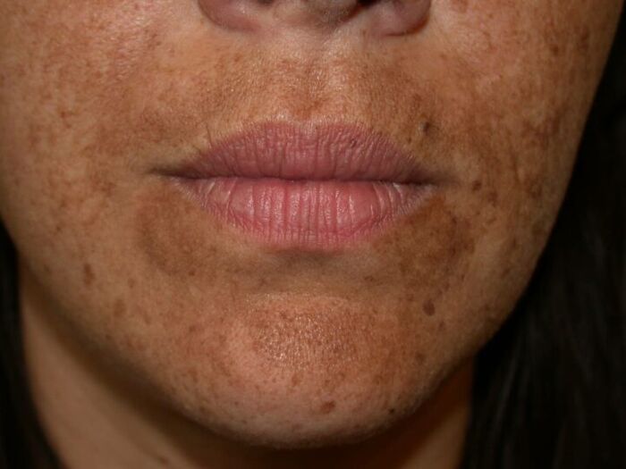Les taches pigmentées sur le visage sont une indication pour une procédure au laser