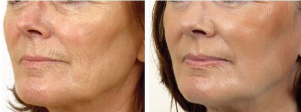 Avant et après le laser peeling