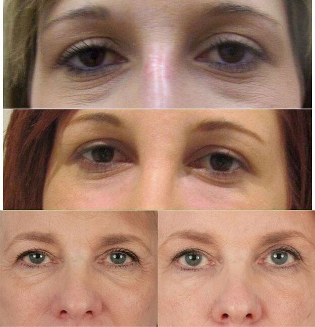 Contour plastique